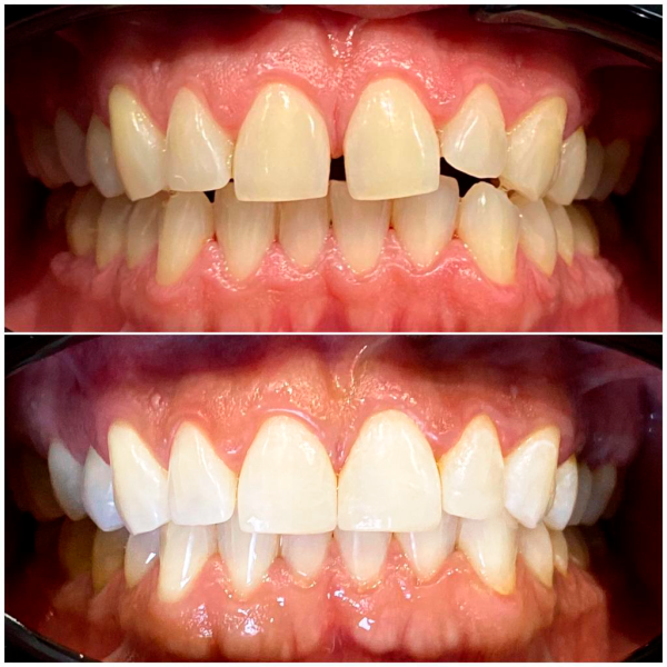 Blanqueamiento Dental comparación